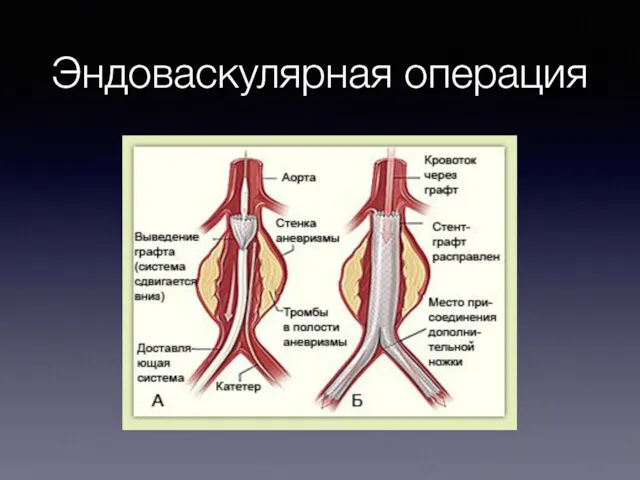 Эндоваскулярная операция