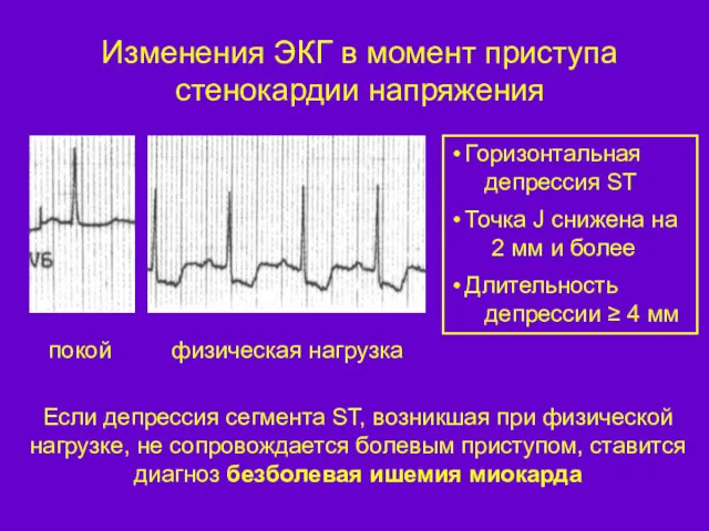 Изменения ЭКГ в момент приступа стенокардии напряжения Если депрессия сегмента