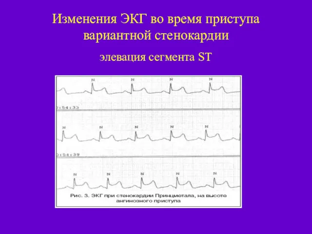 Изменения ЭКГ во время приступа вариантной стенокардии элевация сегмента ST