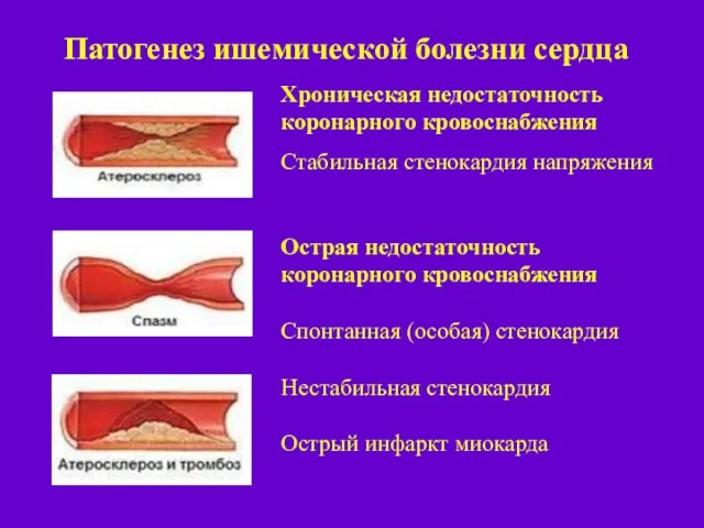 Хроническая недостаточность коронарного кровоснабжения Стабильная стенокардия напряжения Острая недостаточность коронарного