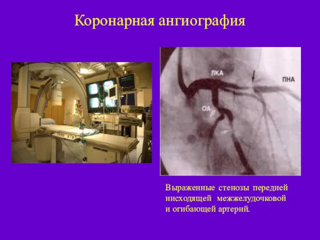 Коронарная ангиография Выраженные стенозы передней нисходящей межжелудочковой и огибающей артерий.