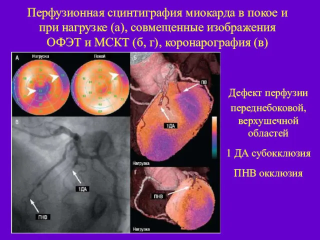 Перфузионная сцинтиграфия миокарда в покое и при нагрузке (а), совмещенные