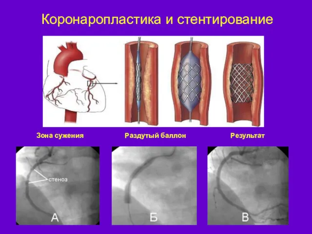 Коронаропластика и стентирование Зона сужения Результат Раздутый баллон