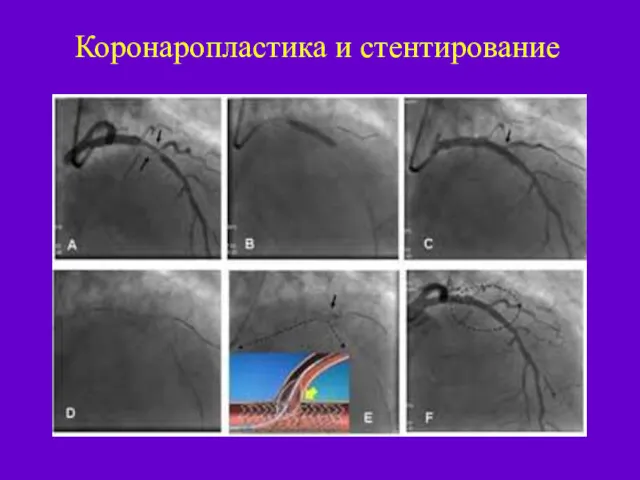 Коронаропластика и стентирование