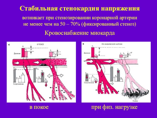 Стабильная стенокардия напряжения возникает при стенозировании коронарной артерии не менее