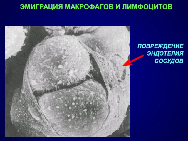 ЭМИГРАЦИЯ МАКРОФАГОВ И ЛИМФОЦИТОВ ПОВРЕЖДЕНИЕ ЭНДОТЕЛИЯ СОСУДОВ