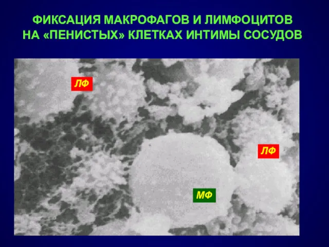 ФИКСАЦИЯ МАКРОФАГОВ И ЛИМФОЦИТОВ НА «ПЕНИСТЫХ» КЛЕТКАХ ИНТИМЫ СОСУДОВ ЛФ ЛФ МФ