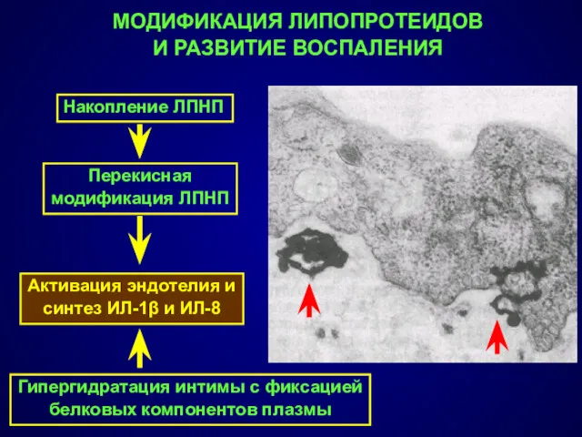 МОДИФИКАЦИЯ ЛИПОПРОТЕИДОВ И РАЗВИТИЕ ВОСПАЛЕНИЯ Активация эндотелия и синтез ИЛ-1β