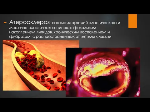 Атеросклероз- патология артерий эластического и мышечно-эластического типов, с фокальным накоплением