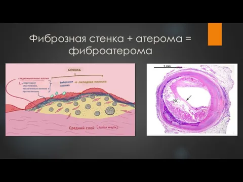 Фиброзная стенка + атерома = фиброатерома