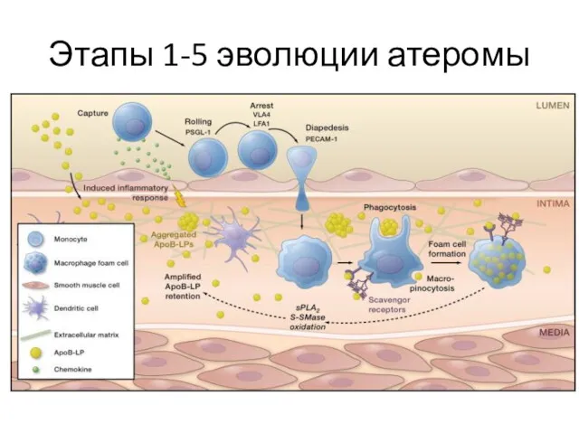 Этапы 1-5 эволюции атеромы