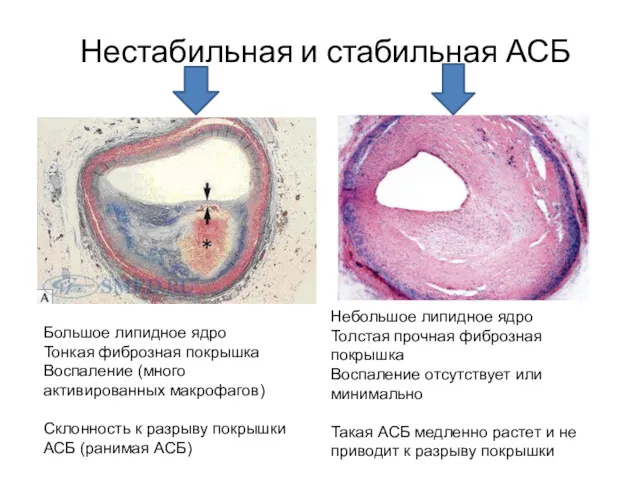 Нестабильная и стабильная АСБ Большое липидное ядро Тонкая фиброзная покрышка