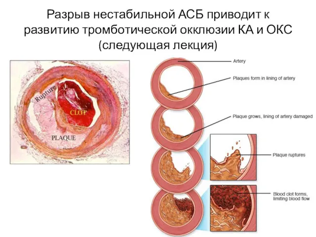 Разрыв нестабильной АСБ приводит к развитию тромботической окклюзии КА и ОКС (следующая лекция)
