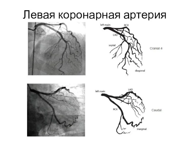 Левая коронарная артерия