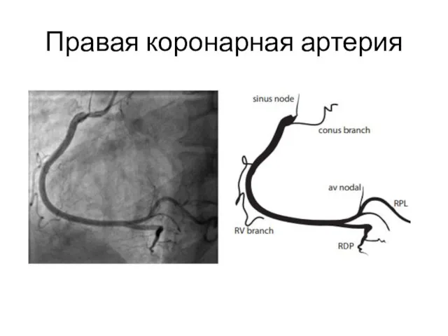 Правая коронарная артерия