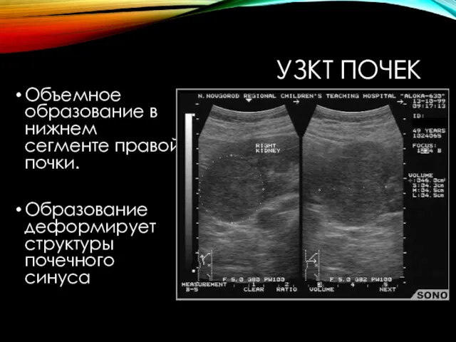 УЗКТ ПОЧЕК Объемное образование в нижнем сегменте правой почки. Образование деформирует структуры почечного синуса