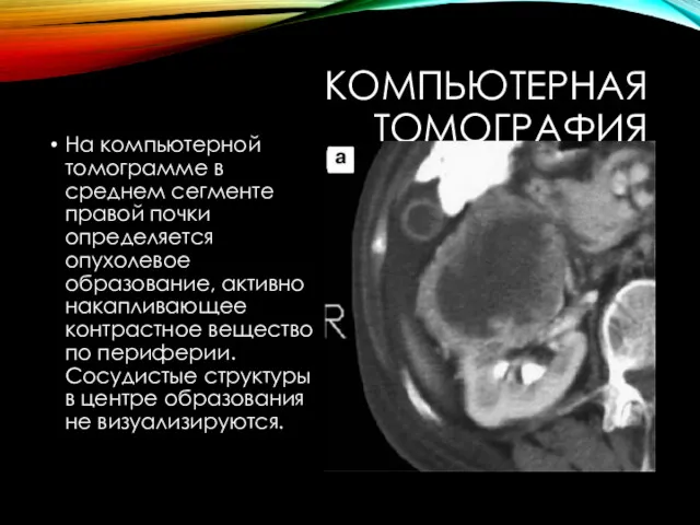 КОМПЬЮТЕРНАЯ ТОМОГРАФИЯ На компьютерной томограмме в среднем сегменте правой почки