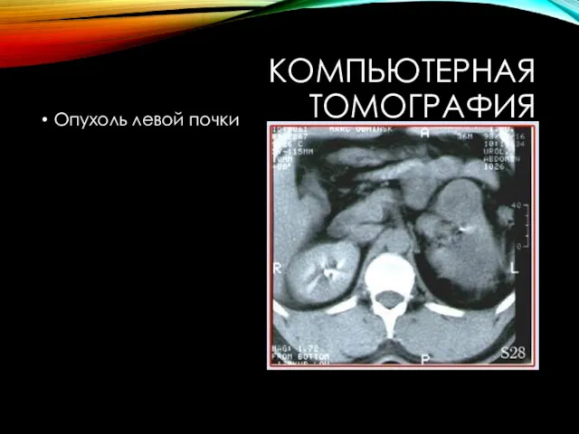 КОМПЬЮТЕРНАЯ ТОМОГРАФИЯ Опухоль левой почки