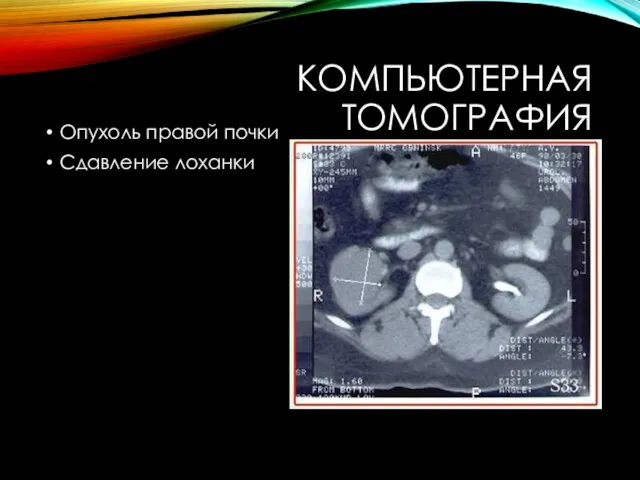 КОМПЬЮТЕРНАЯ ТОМОГРАФИЯ Опухоль правой почки Сдавление лоханки