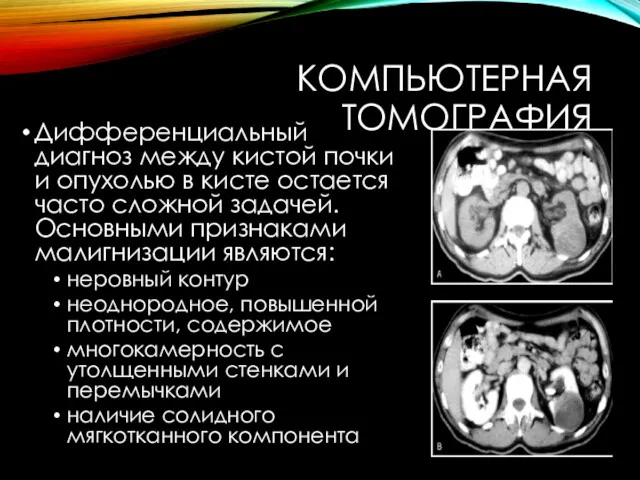 КОМПЬЮТЕРНАЯ ТОМОГРАФИЯ Дифференциальный диагноз между кистой почки и опухолью в