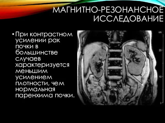 МАГНИТНО-РЕЗОНАНСНОЕ ИССЛЕДОВАНИЕ При контрастном усилении рак почки в большинстве случаев