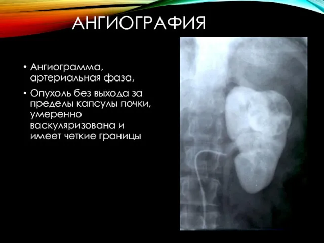 АНГИОГРАФИЯ Ангиограмма, артериальная фаза, Опухоль без выхода за пределы капсулы