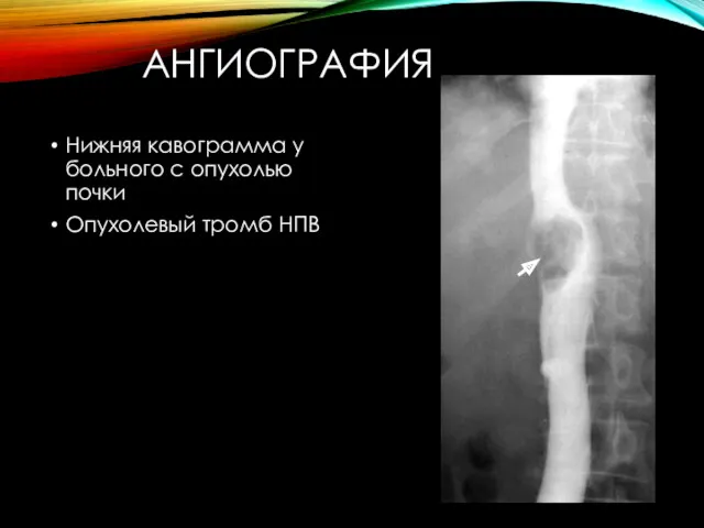 АНГИОГРАФИЯ Нижняя кавограмма у больного с опухолью почки Опухолевый тромб НПВ