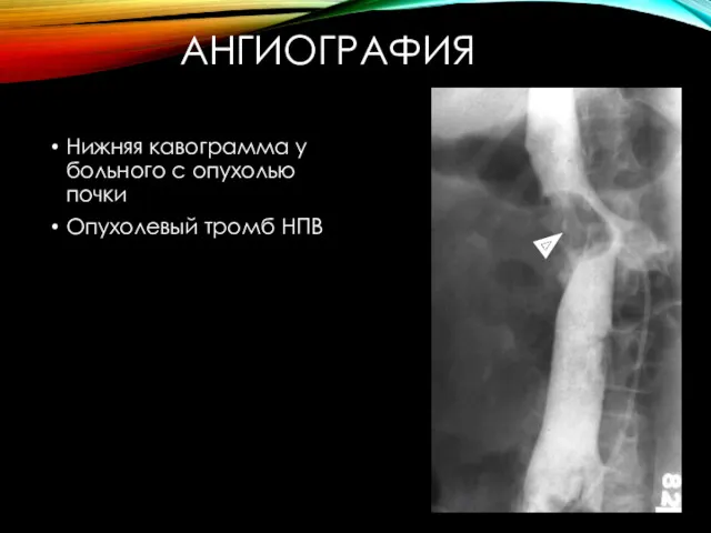 АНГИОГРАФИЯ Нижняя кавограмма у больного с опухолью почки Опухолевый тромб НПВ