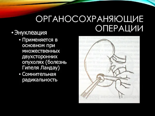 ОРГАНОСОХРАНЯЮЩИЕ ОПЕРАЦИИ Энуклеация Применяется в основном при множественных двухсторонних опухолях (болезнь Гипеля Ландау) Сомнительная радикальность