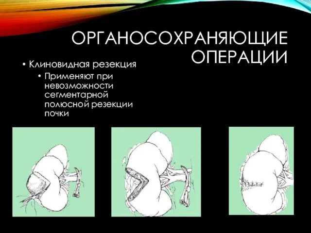 ОРГАНОСОХРАНЯЮЩИЕ ОПЕРАЦИИ Клиновидная резекция Применяют при невозможности сегментарной полюсной резекции почки