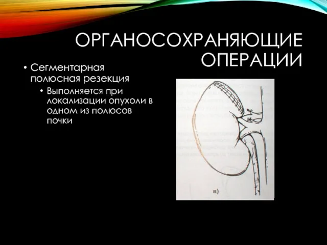 ОРГАНОСОХРАНЯЮЩИЕ ОПЕРАЦИИ Сегментарная полюсная резекция Выполняется при локализации опухоли в одном из полюсов почки