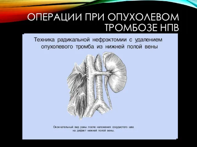 ОПЕРАЦИИ ПРИ ОПУХОЛЕВОМ ТРОМБОЗЕ НПВ