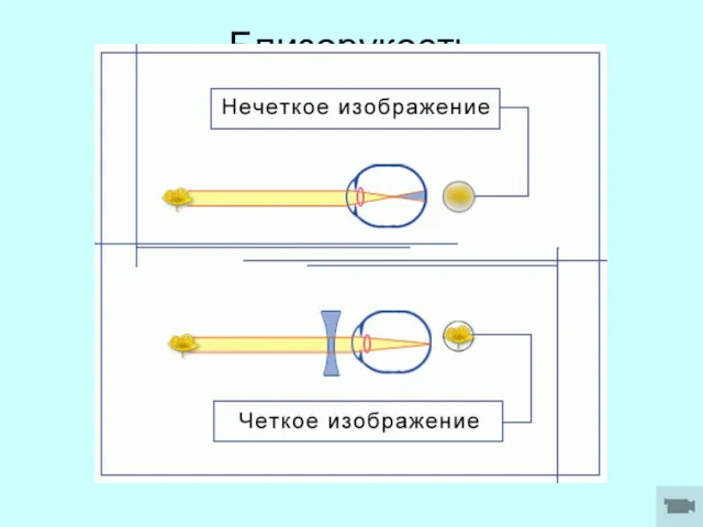 Близорукость