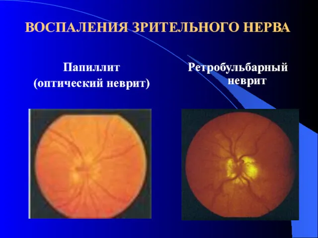 ВОСПАЛЕНИЯ ЗРИТЕЛЬНОГО НЕРВА Папиллит (оптический неврит) Ретробульбарный неврит