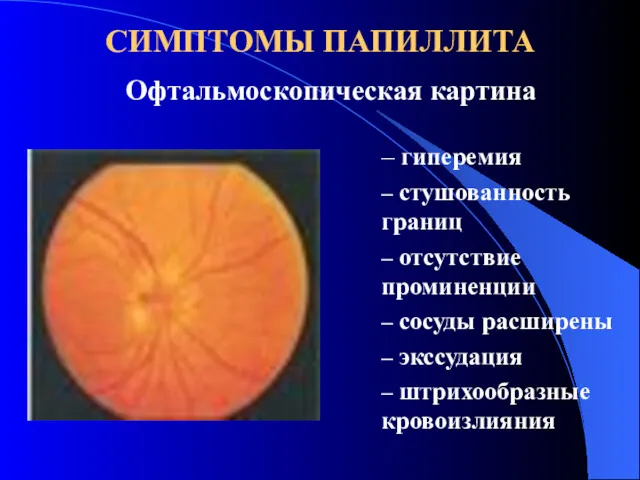 СИМПТОМЫ ПАПИЛЛИТА Офтальмоскопическая картина гиперемия стушованность границ отсутствие проминенции сосуды расширены экссудация штрихообразные кровоизлияния