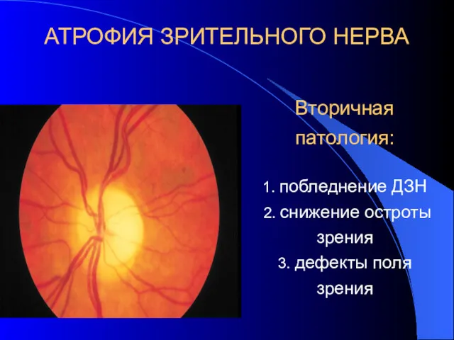 АТРОФИЯ ЗРИТЕЛЬНОГО НЕРВА Вторичная патология: 1. побледнение ДЗН 2. снижение остроты зрения 3. дефекты поля зрения