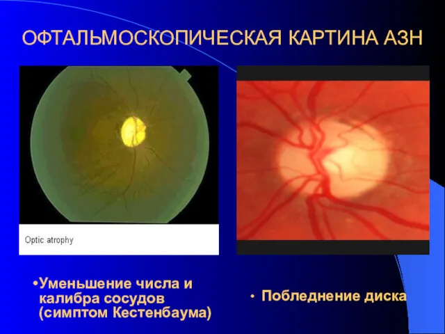 ОФТАЛЬМОСКОПИЧЕСКАЯ КАРТИНА АЗН Побледнение диска Уменьшение числа и калибра сосудов (симптом Кестенбаума)