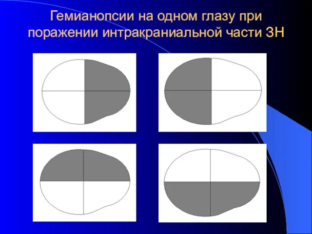 Гемианопсии на одном глазу при поражении интракраниальной части ЗН