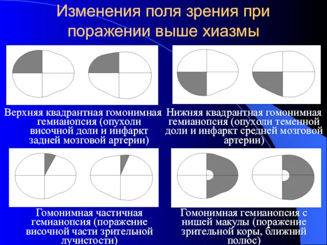 Изменения поля зрения при поражении выше хиазмы Верхняя квадрантная гомонимная