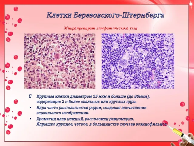 Клетки Березовского-Штернберга Крупные клетки диаметром 25 мкм и больше (до 80мкм), содержащие 2