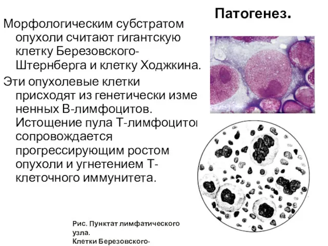 Патогенез. Морфологическим субстратом опухоли считают гигантскую клетку Березовского-Штернберга и клетку