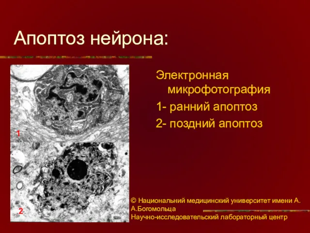 Апоптоз нейрона: Электронная микрофотография 1- ранний апоптоз 2- поздний апоптоз