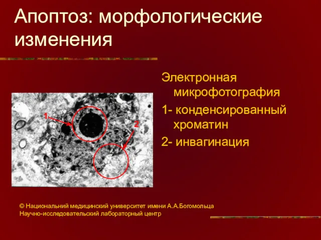 Апоптоз: морфологические изменения Электронная микрофотография 1- конденсированный хроматин 2- инвагинация