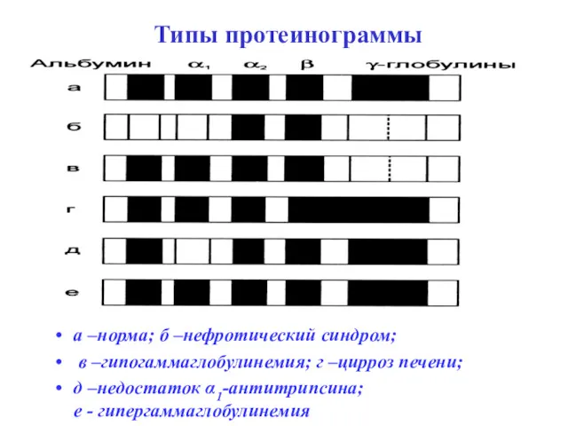 Типы протеинограммы а –норма; б –нефротический синдром; в –гипогаммаглобулинемия; г