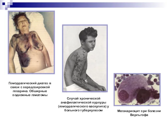 Геморрагический диатез в связи с передозировкой гепарина. Обширные подкожные гематомы