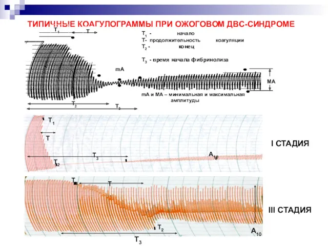 ТИПИЧНЫЕ КОАГУЛОГРАММЫ ПРИ ОЖОГОВОМ ДВС-СИНДРОМЕ I СТАДИЯ Т1 Т2 Т3