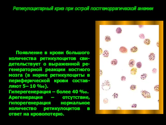 Ретикулоцитарный криз при острой постгеморрагической анемии Появление в крови большого