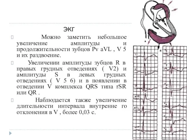 ЭКГ Можно заметить небольшое увеличение амплитуды и продолжительности зубцов Pv