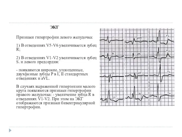 ЭКГ Признаки гипертрофии левого желудочка: 1) В отведениях V5-V6 увеличивается