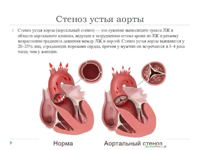 Стеноз устья аорты Стеноз устья аорты (аортальный стеноз) — это